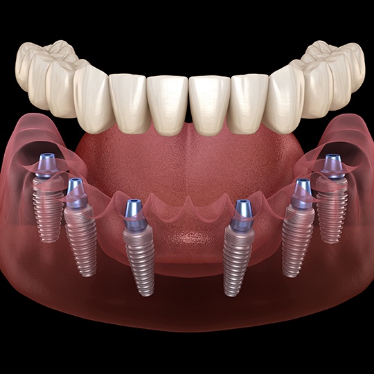 Digital illustration of implant dentures