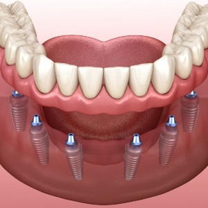 Illustration of implant dentures