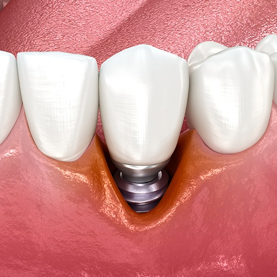 Digital image of dental implant between two natural teeth