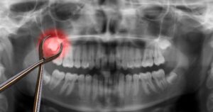 X-ray of someone's mouth with wisdom tooth highlighted red surrounded by forceps