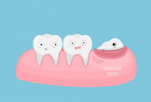 Illustration of three teeth: one is trying to erupt, the other two are freaking out